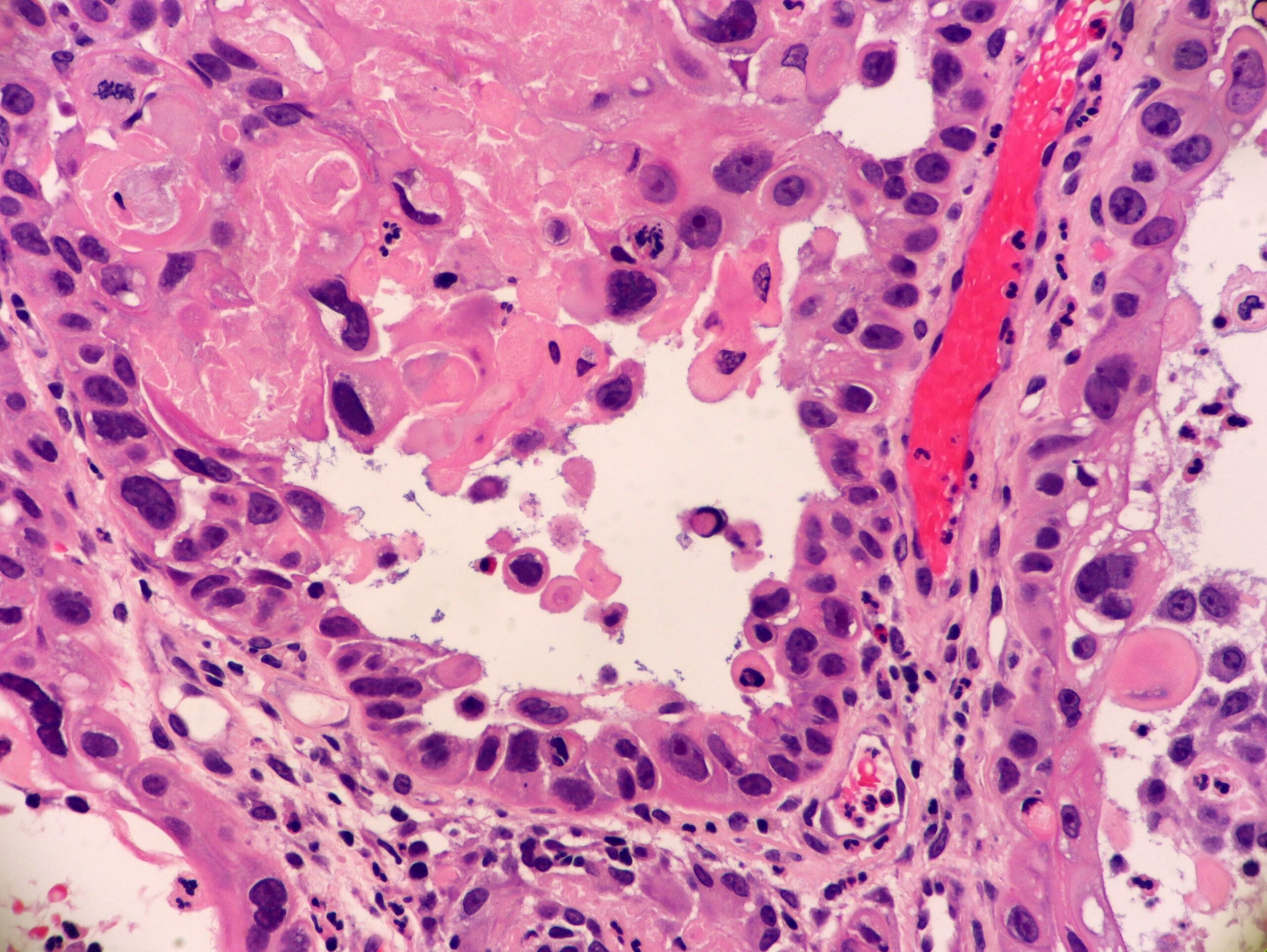 Acantholytic Squamous Cell Carcinoma