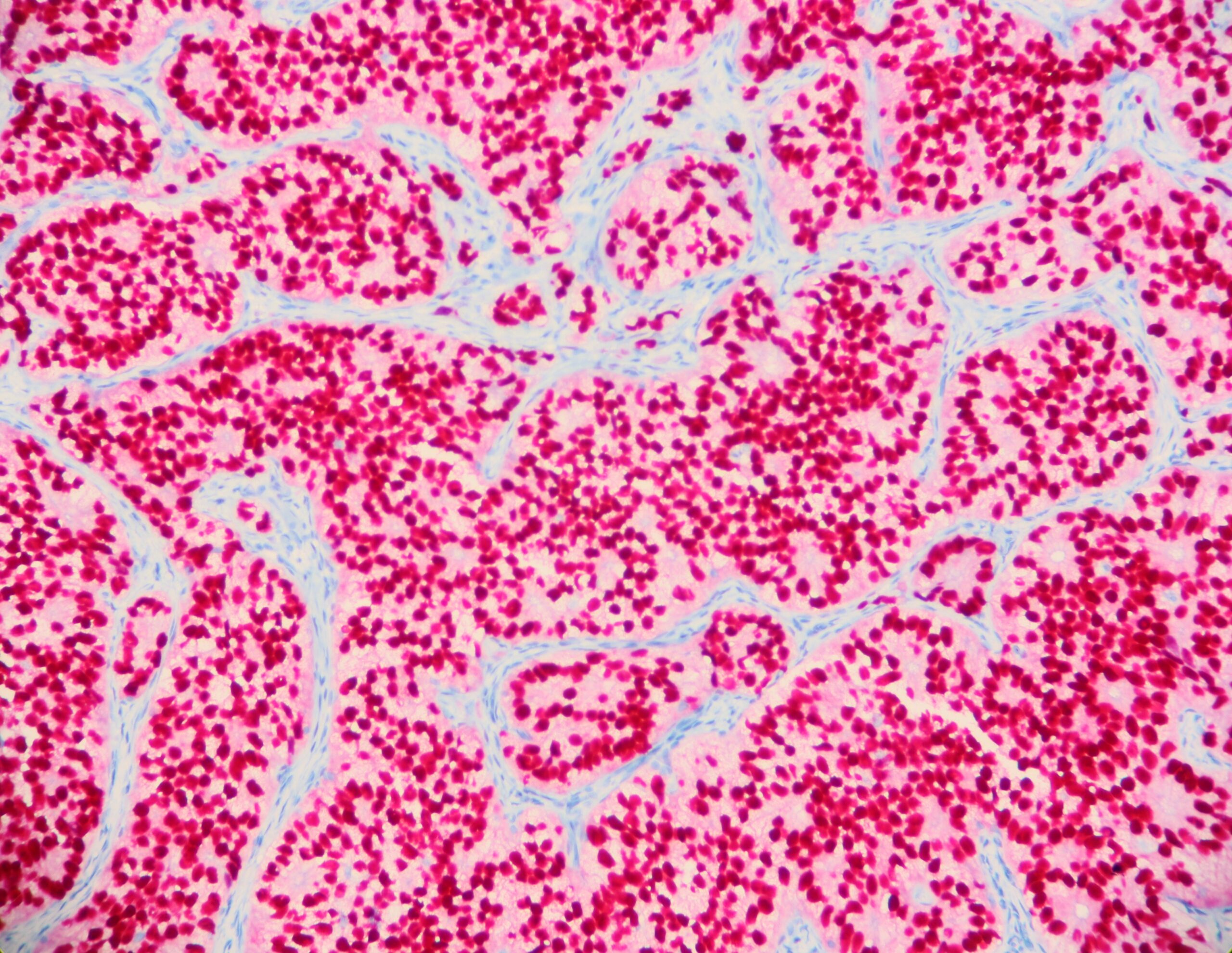 Androgen Receptor Expression in High Grade Prostate Cancer