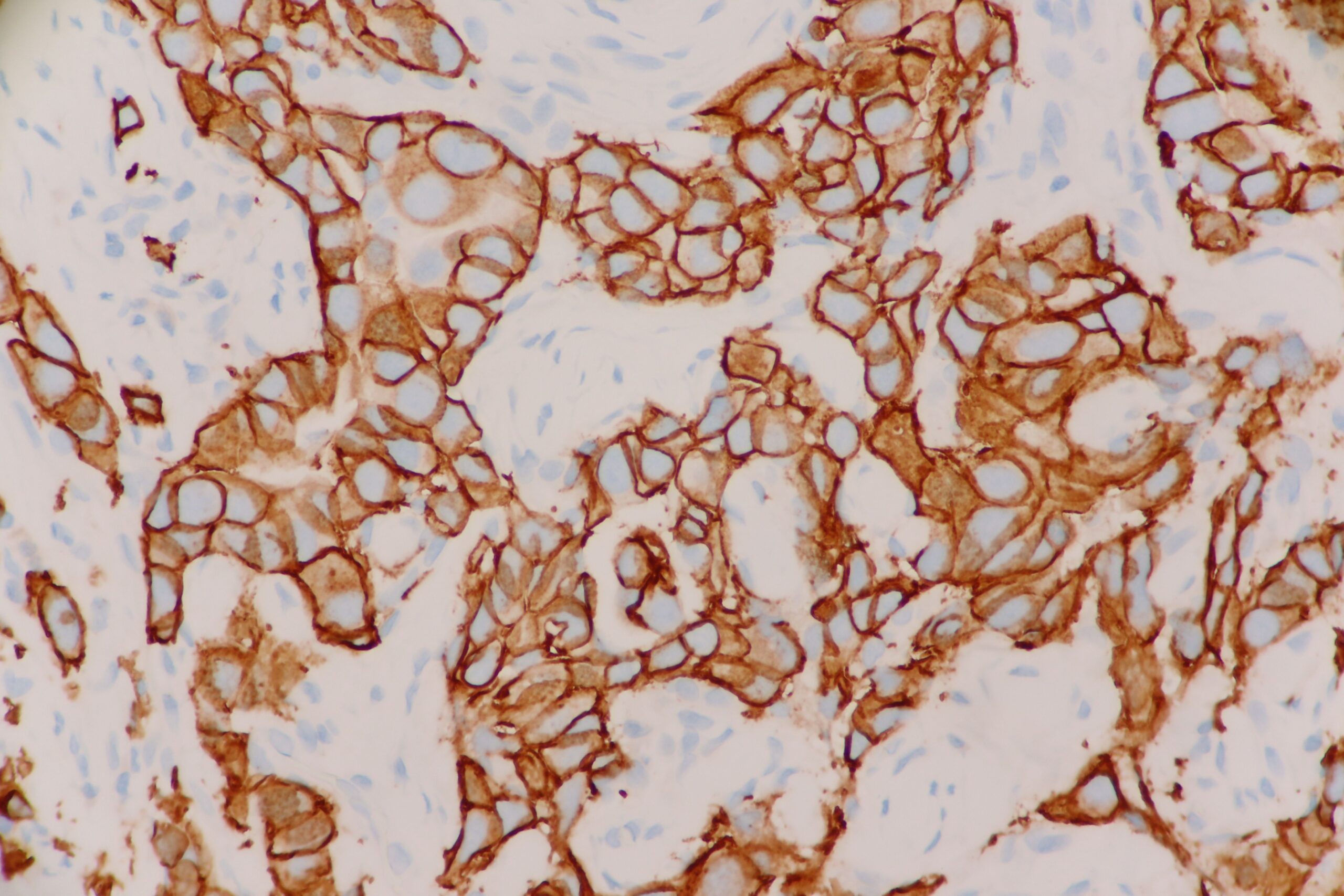 Breast Invasive Ductal Carcinoma Her2neu Positive