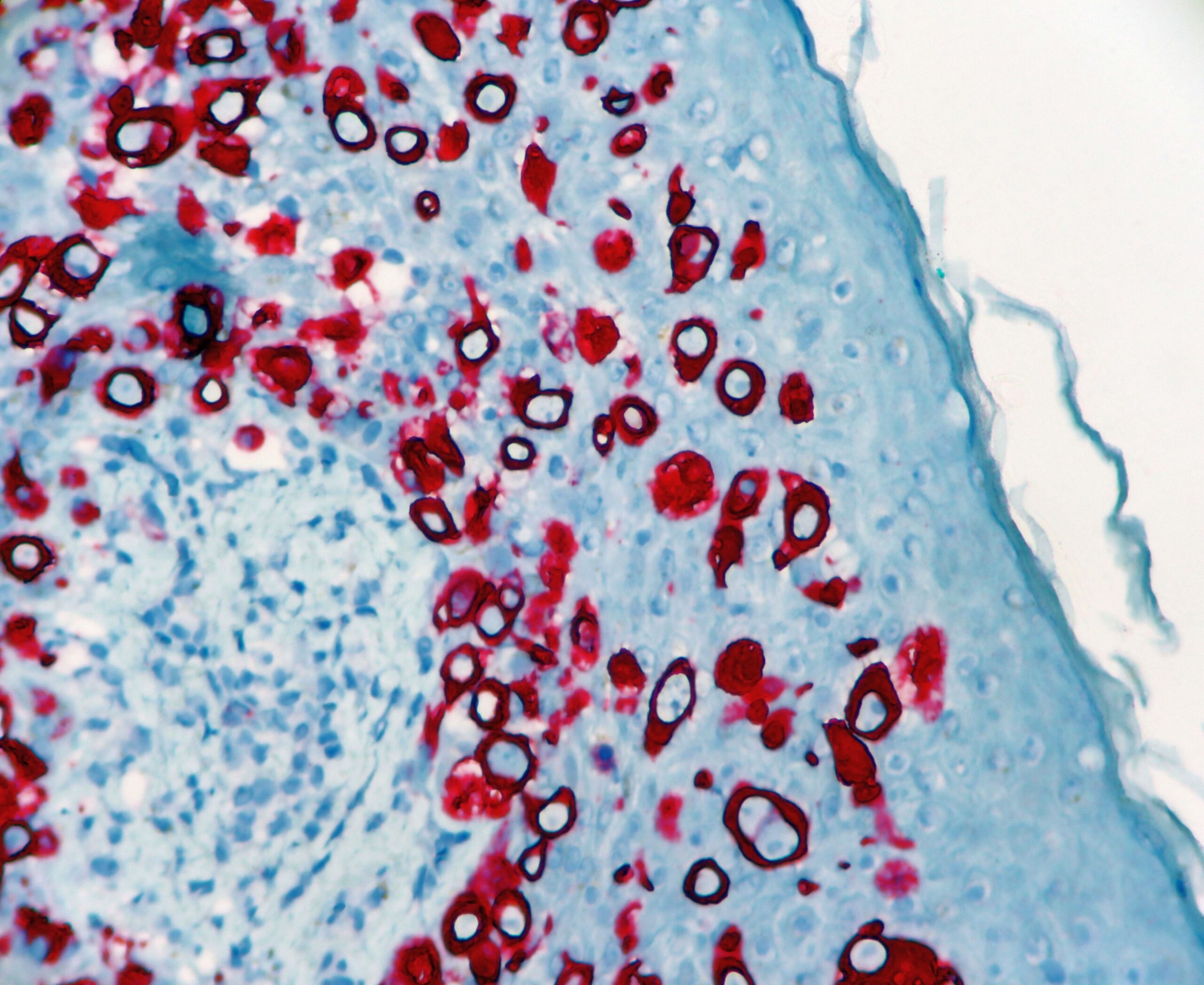 CK7 Expresion in Paget Disease
