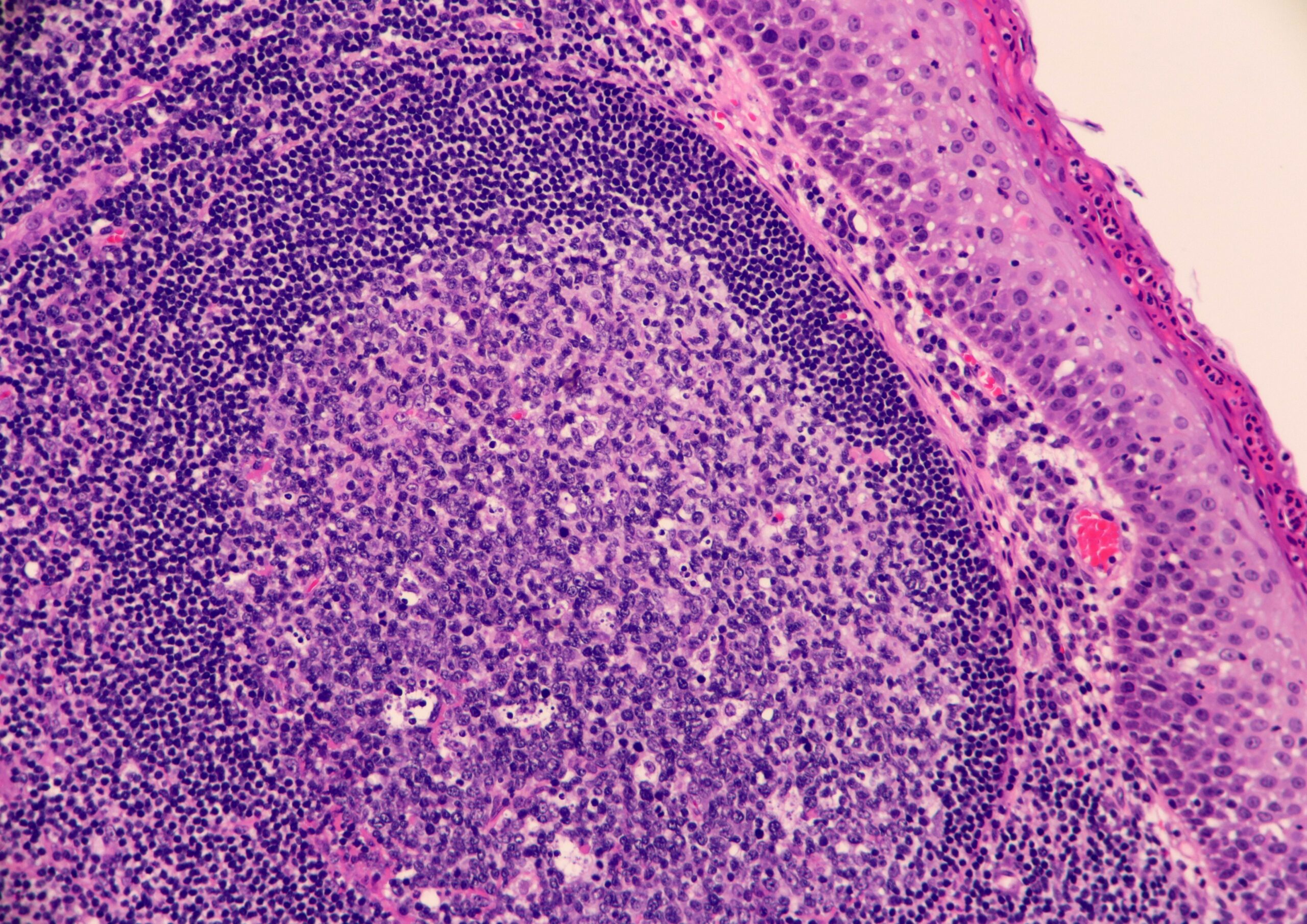 Chronic Tonsillitis, Follicular Hyperplasia