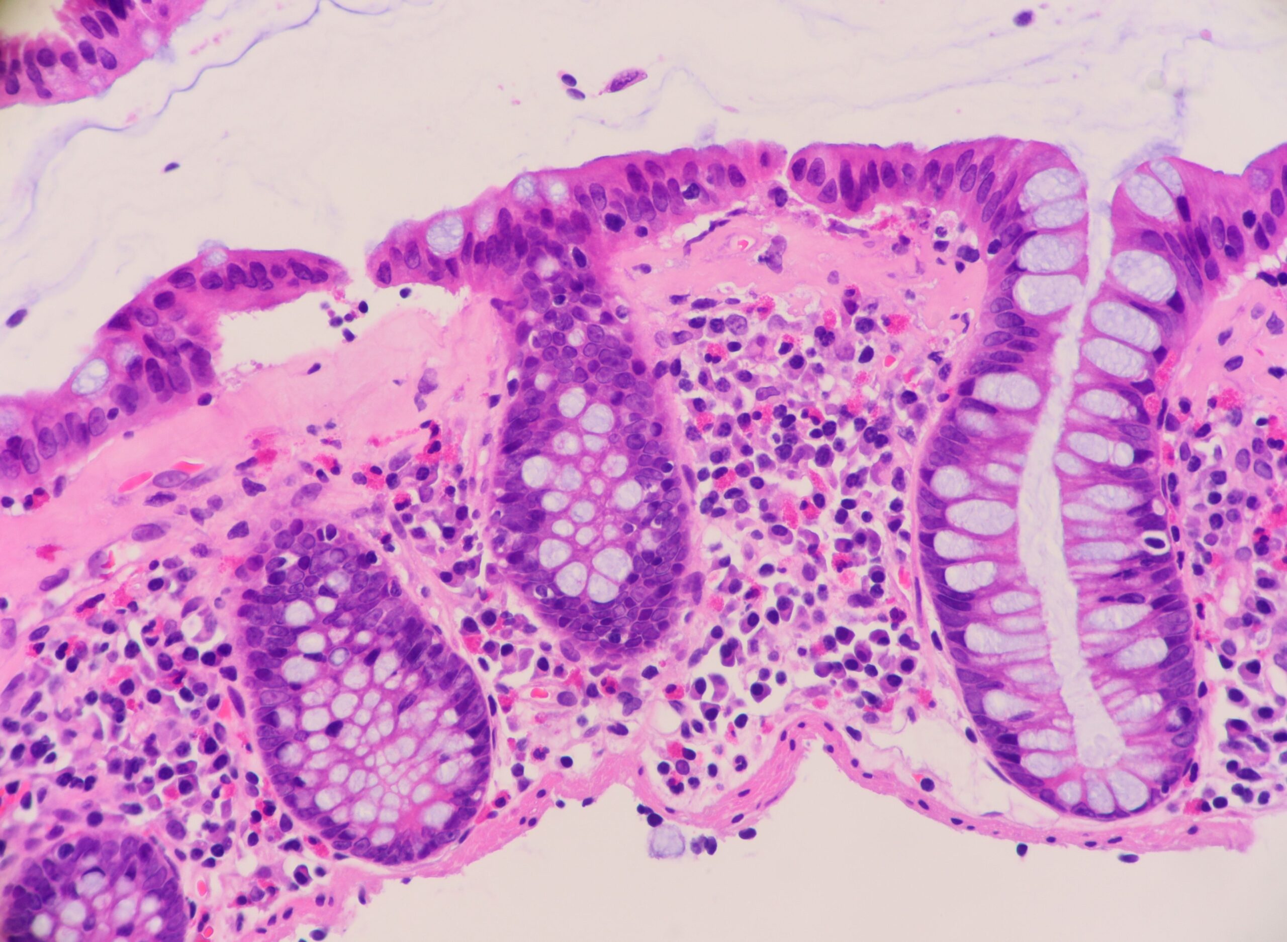 Collagenous Colitis