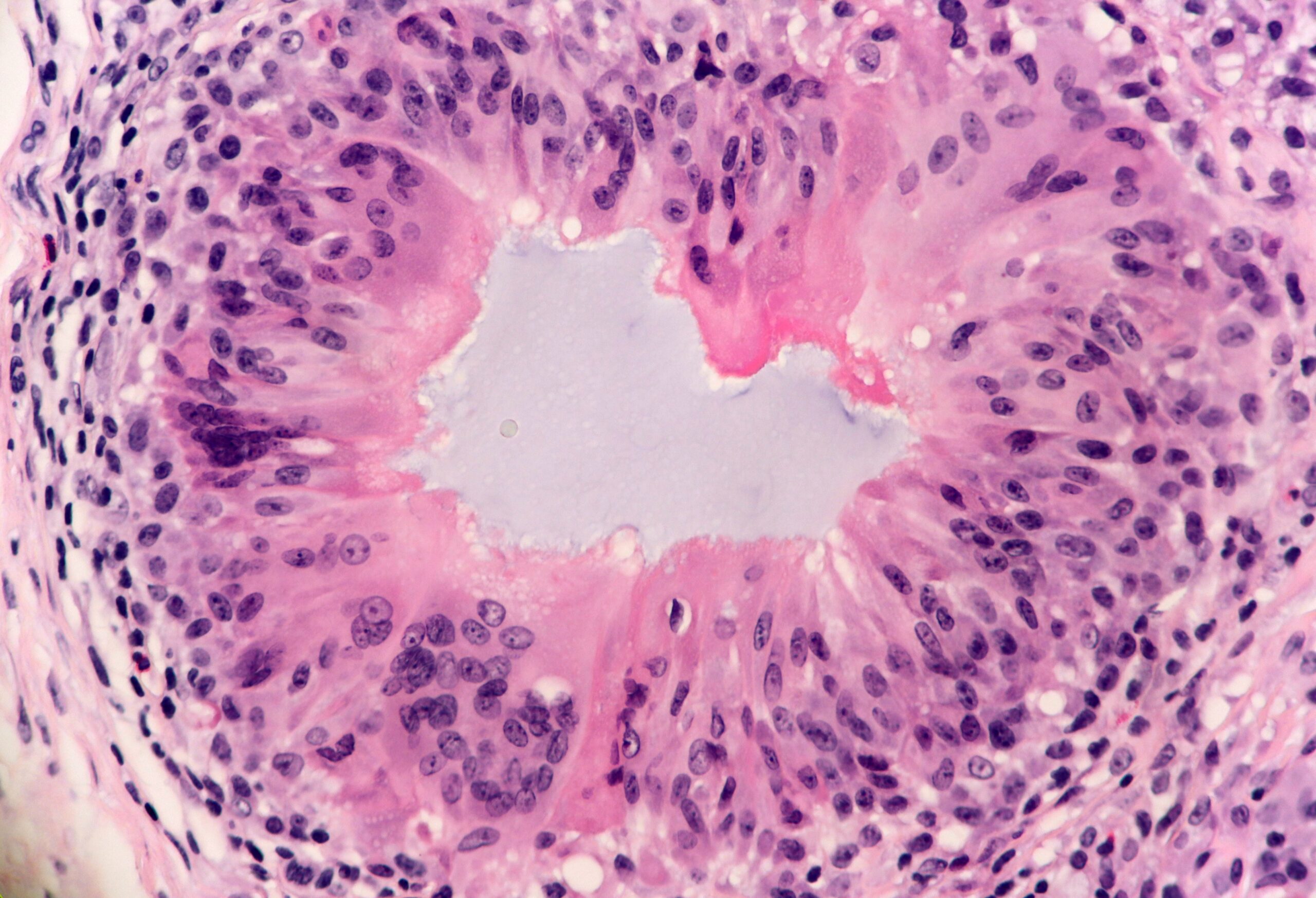 Dermal Filler with Granulomatous Reaction