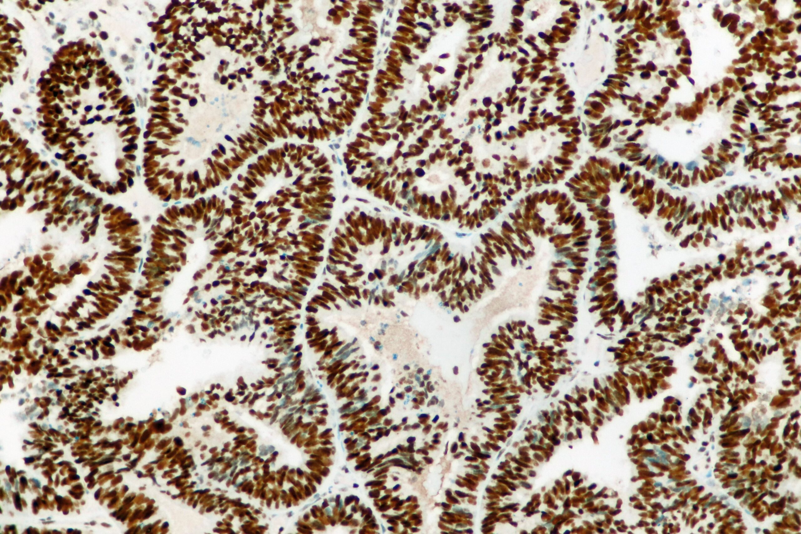 Endometrial Carcinoma MSH2 Positive