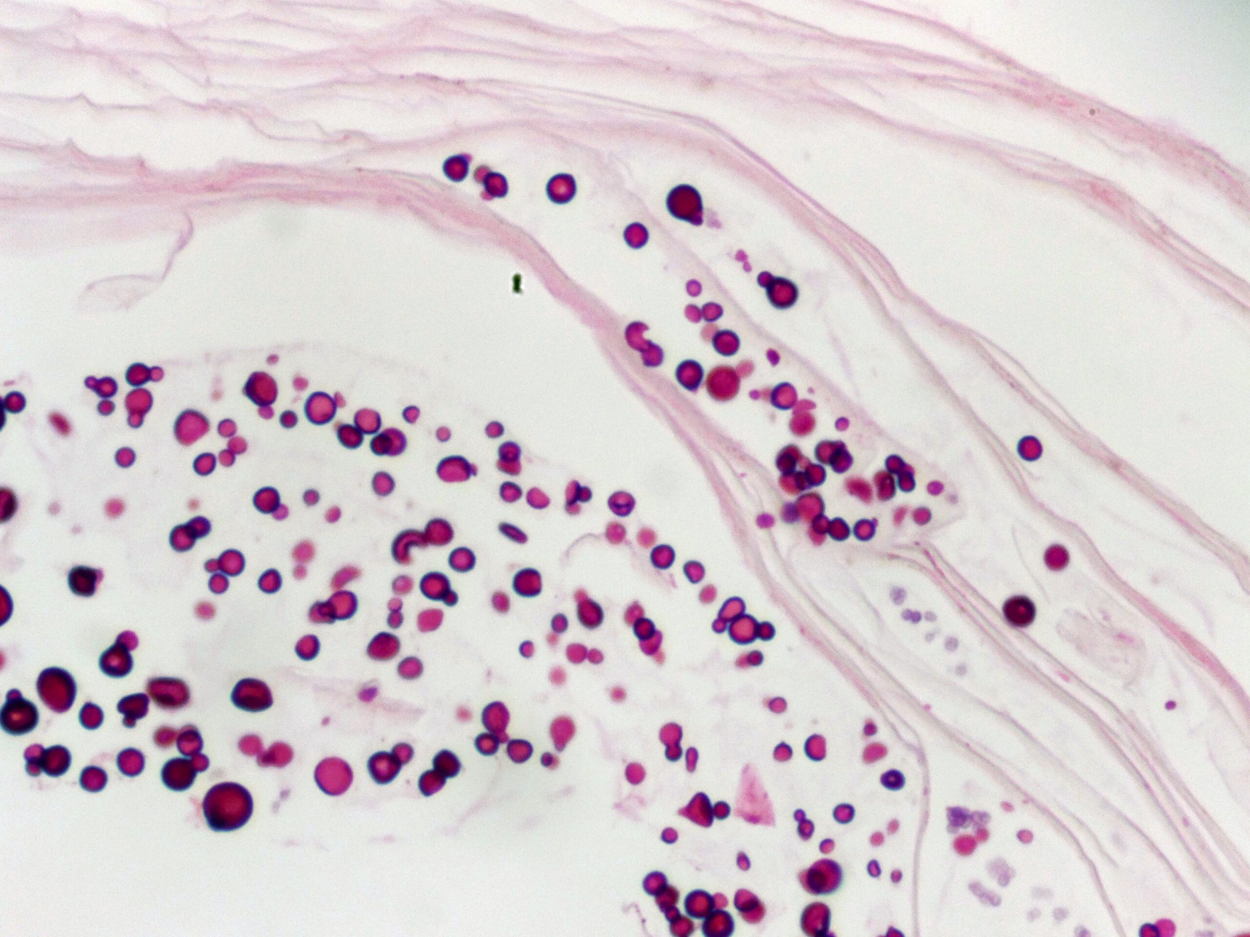 Fungal Spores in the Stratum Corneum