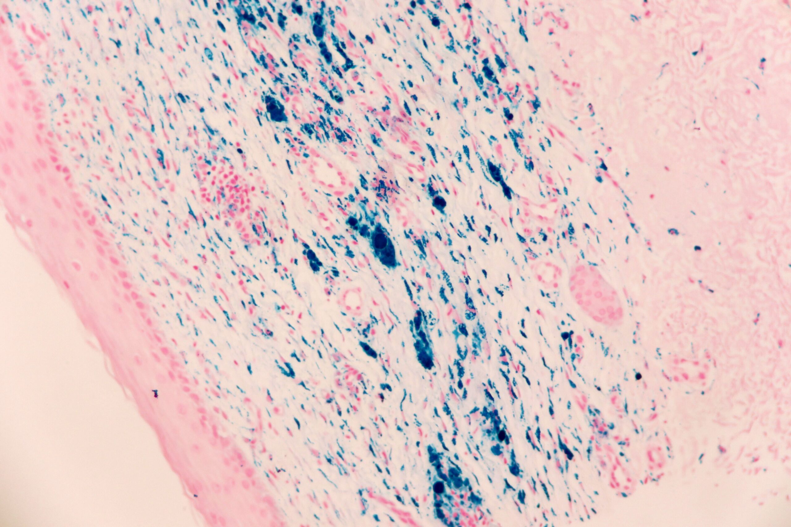 Hemosiderin Deposits in the Skin, Iron Stain
