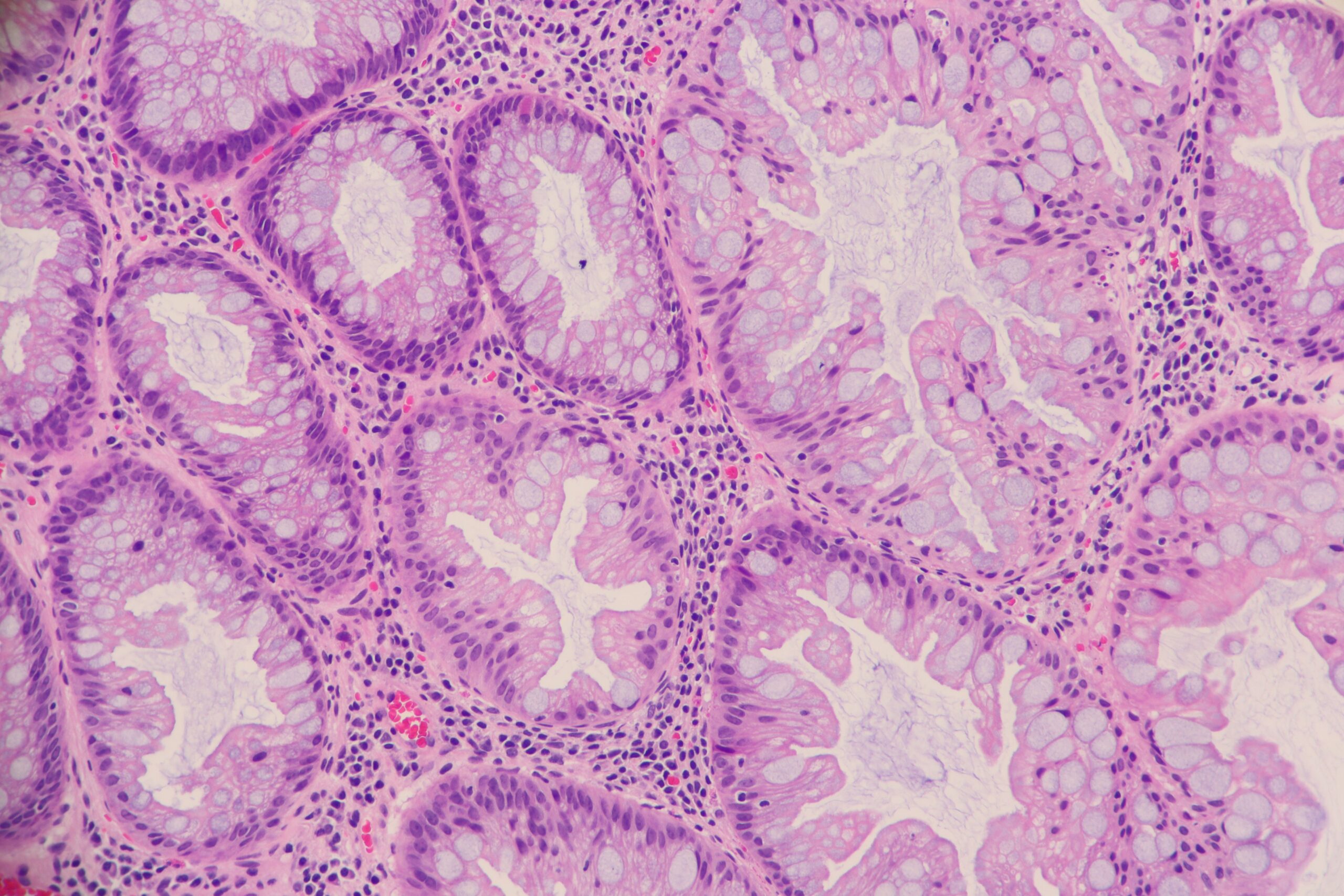 Hyperplastic Polyp of the Colon