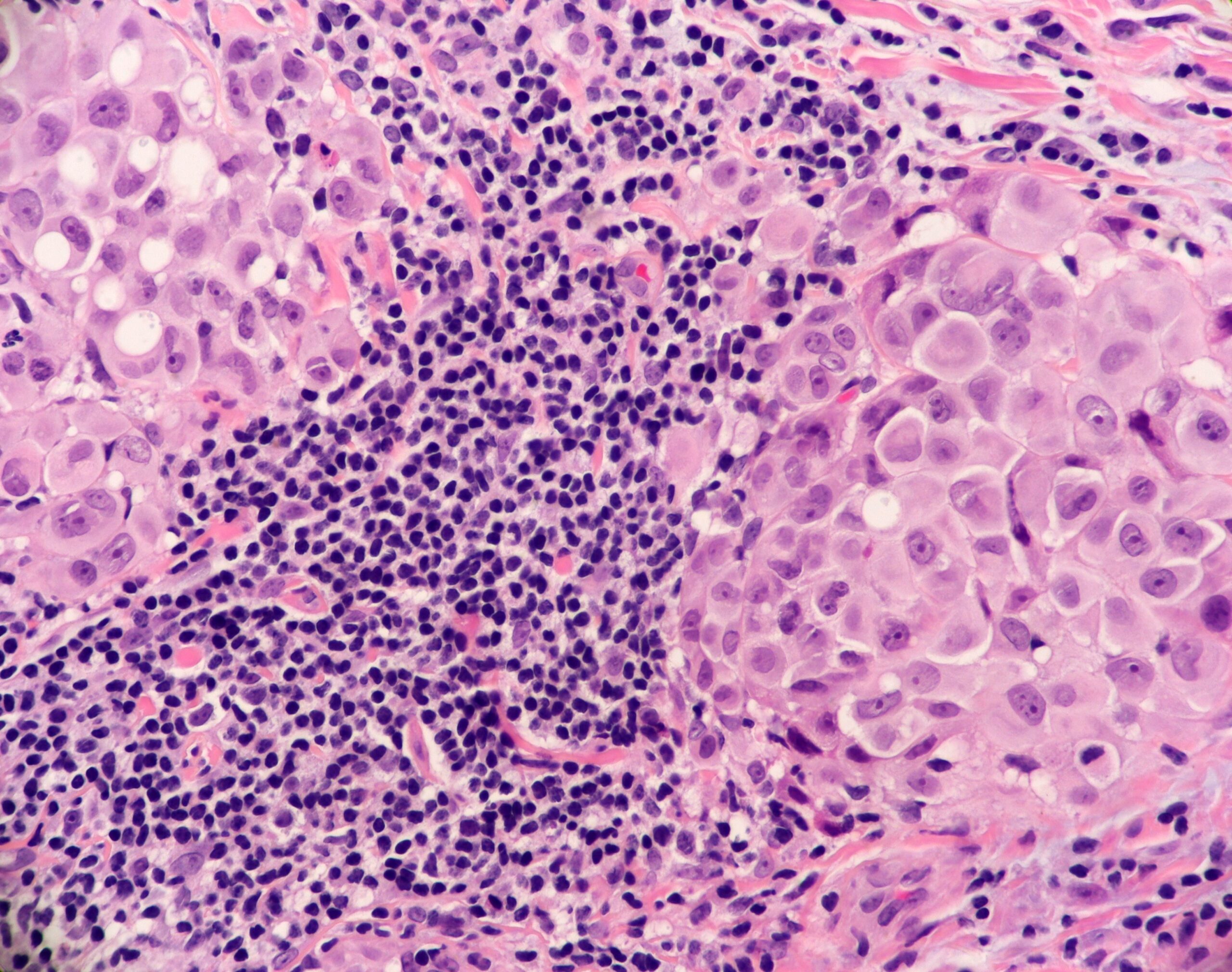 Metastatic Malignant Melanoma with Tumor Infiltrating Lymphocytes