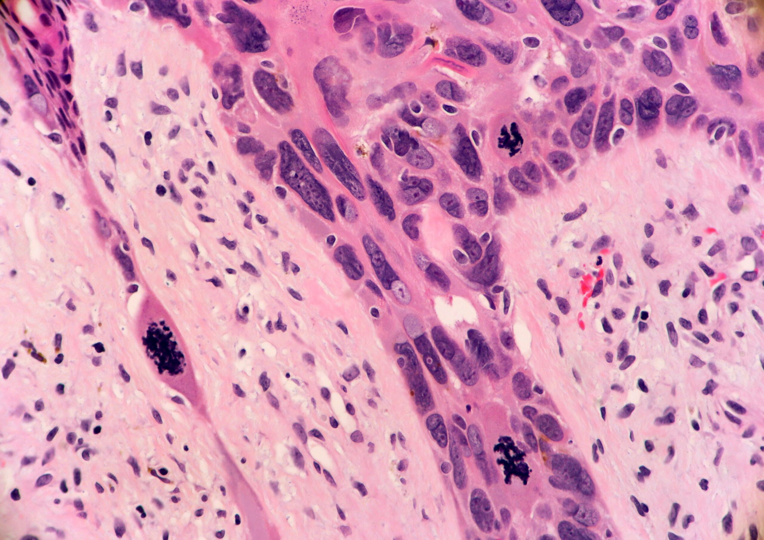 Metatypical Basal Cell Carcinoma