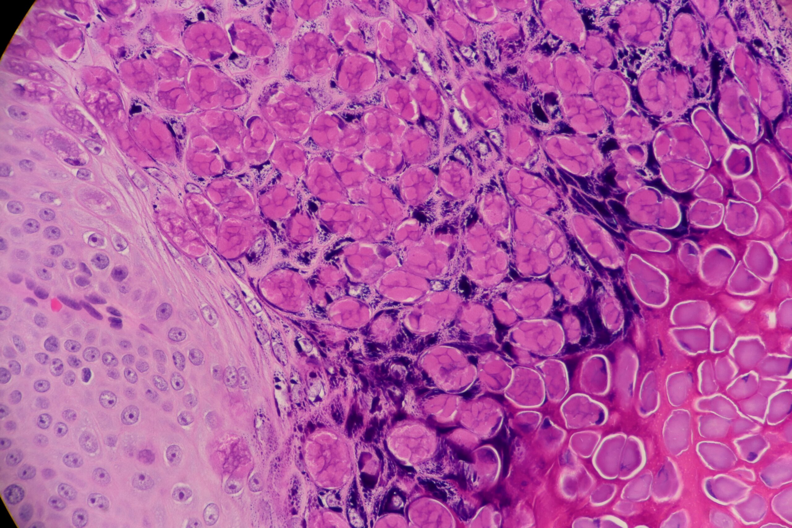 Molluscum Contagiosum