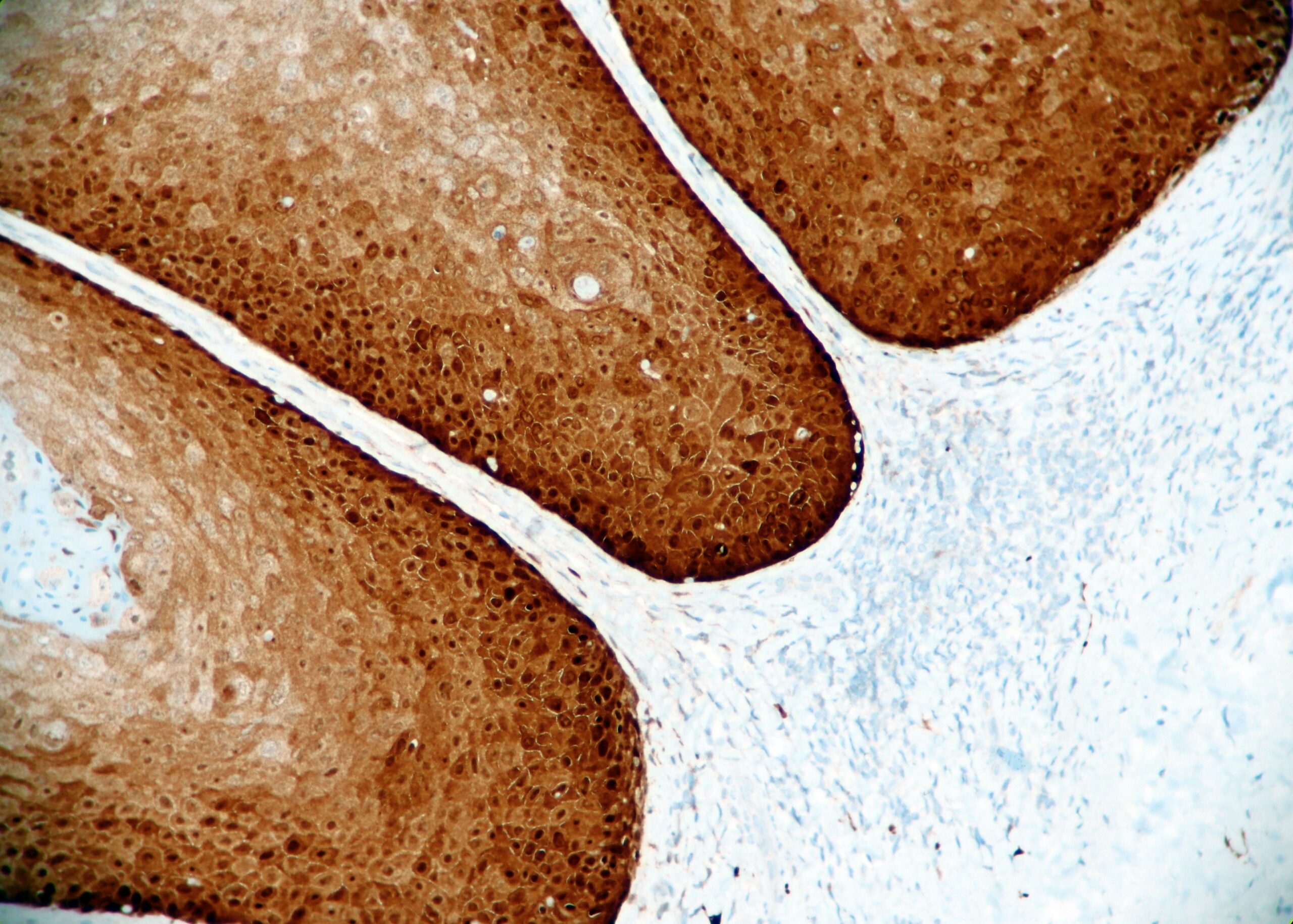 P16 Expression in Dysplasia of the Foreskin