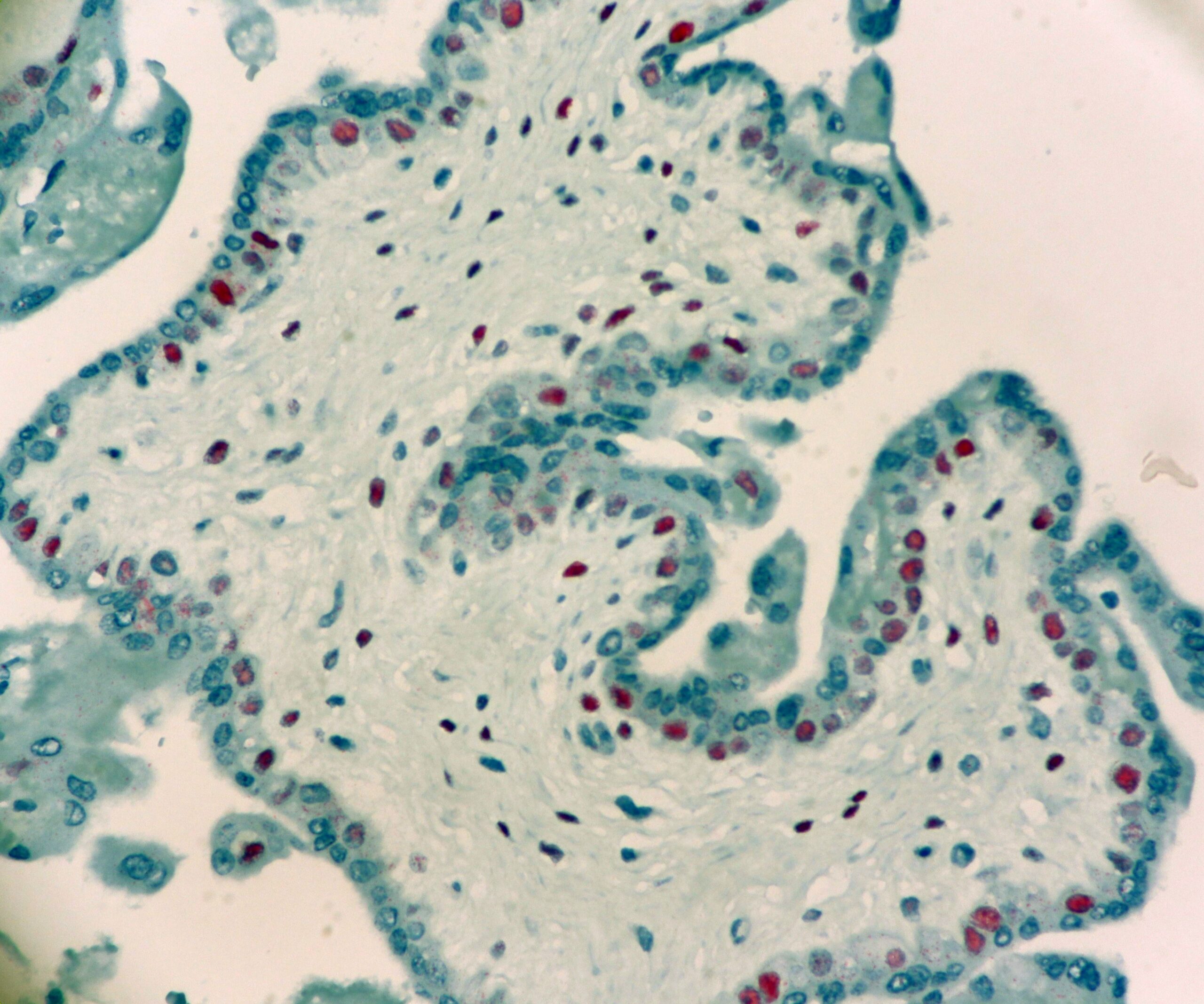 P57 Expression in Chorionic Villi