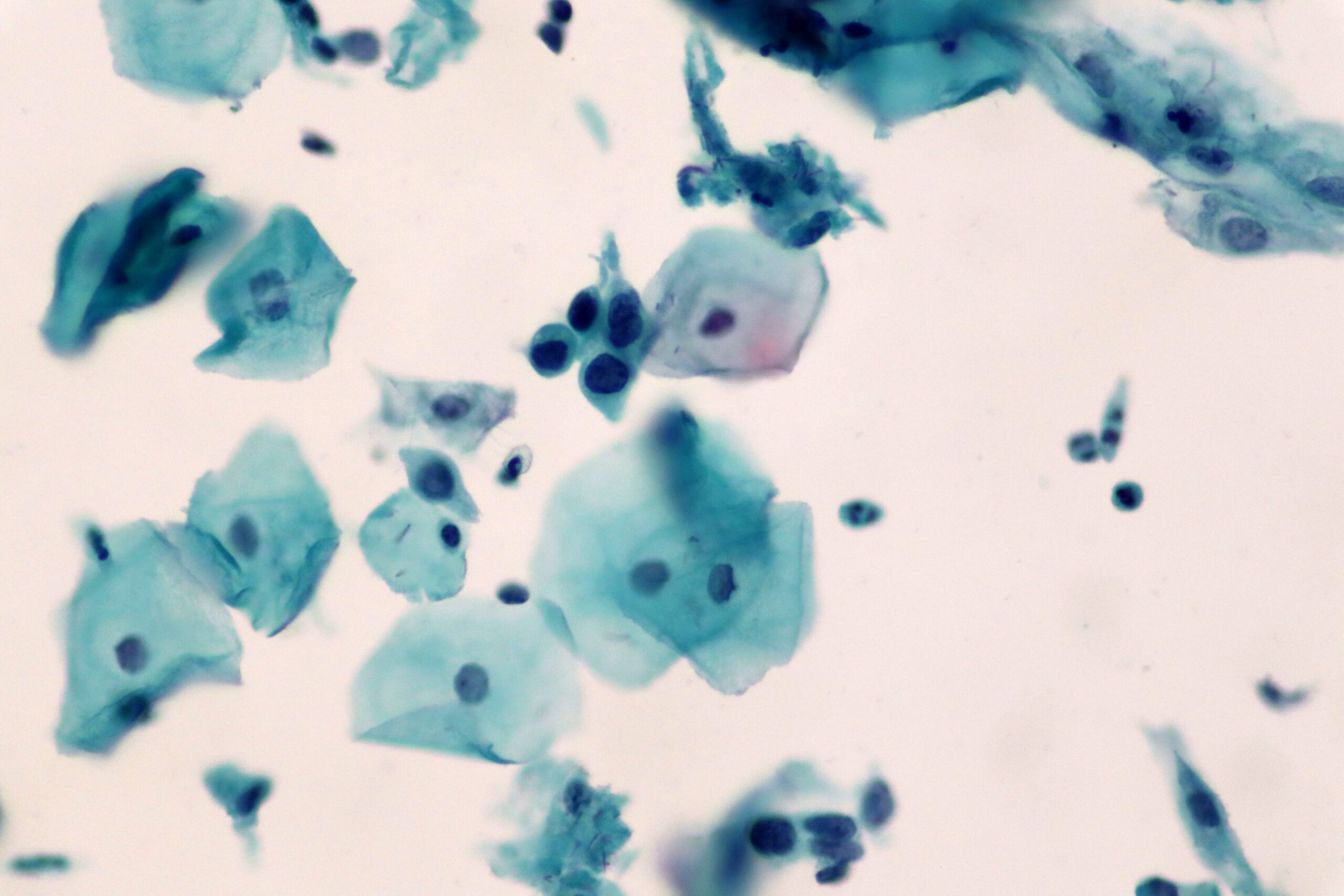 Pap Smear with HSIL