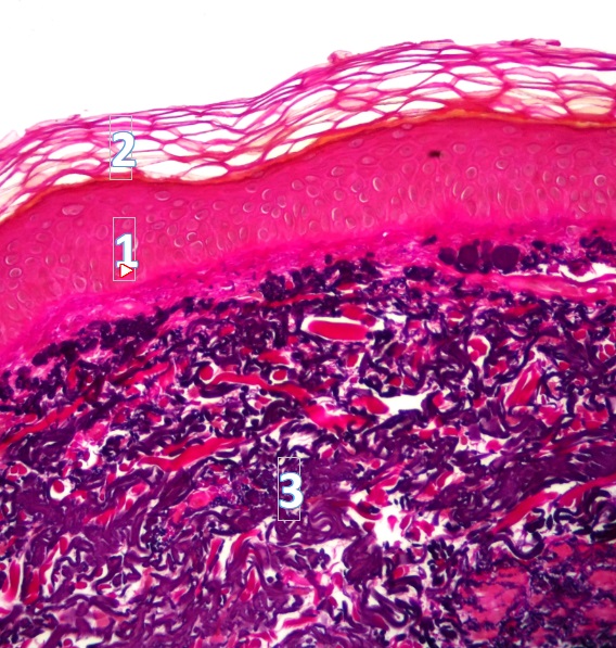 Sun Damaged Skin or Solar Elastosis