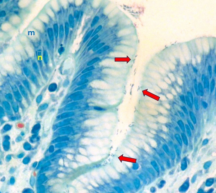 Stomach Infection Caused by Helicobacter Pylori Bacteria