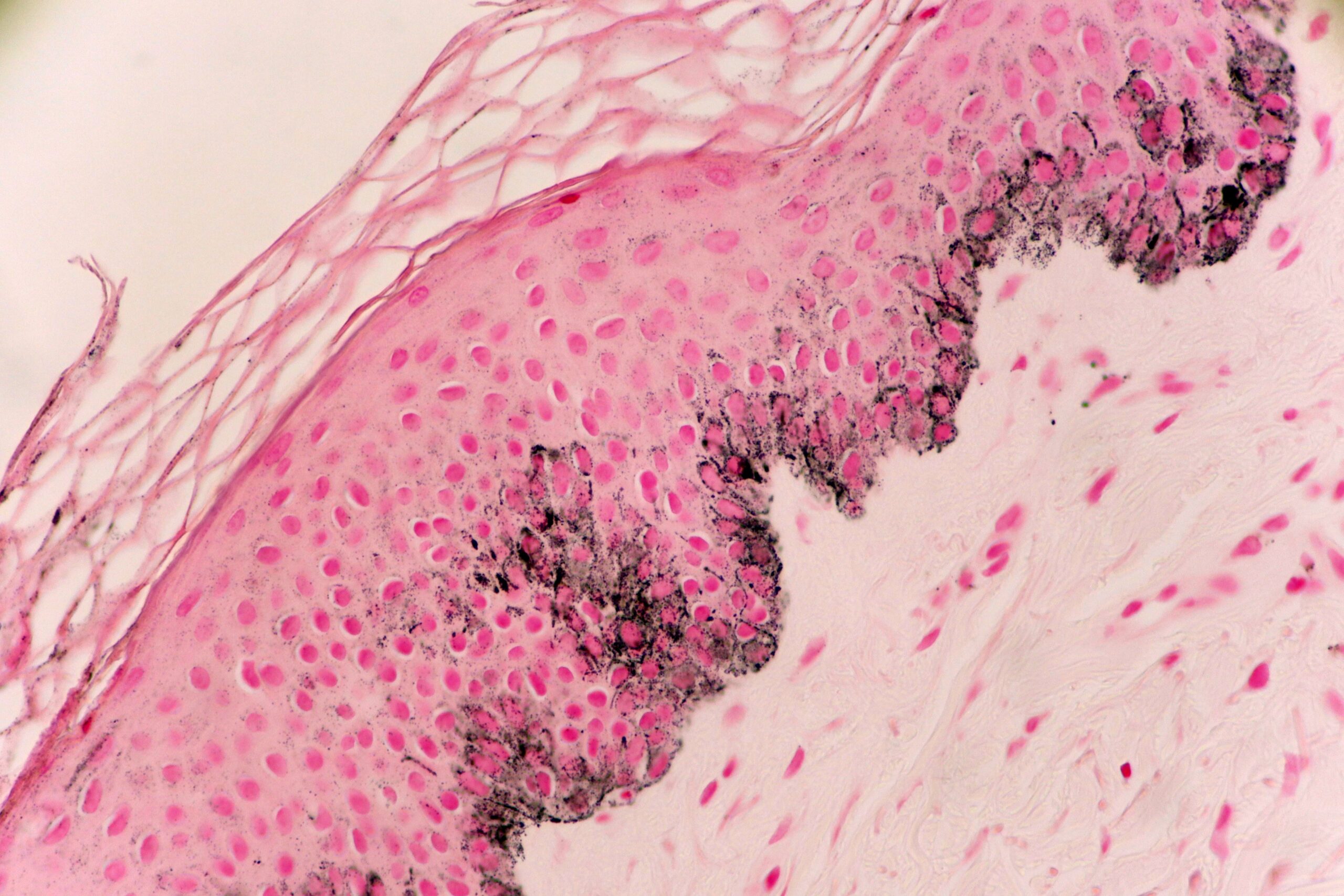 Skin Fontana Stain Showing Melanin Pigment