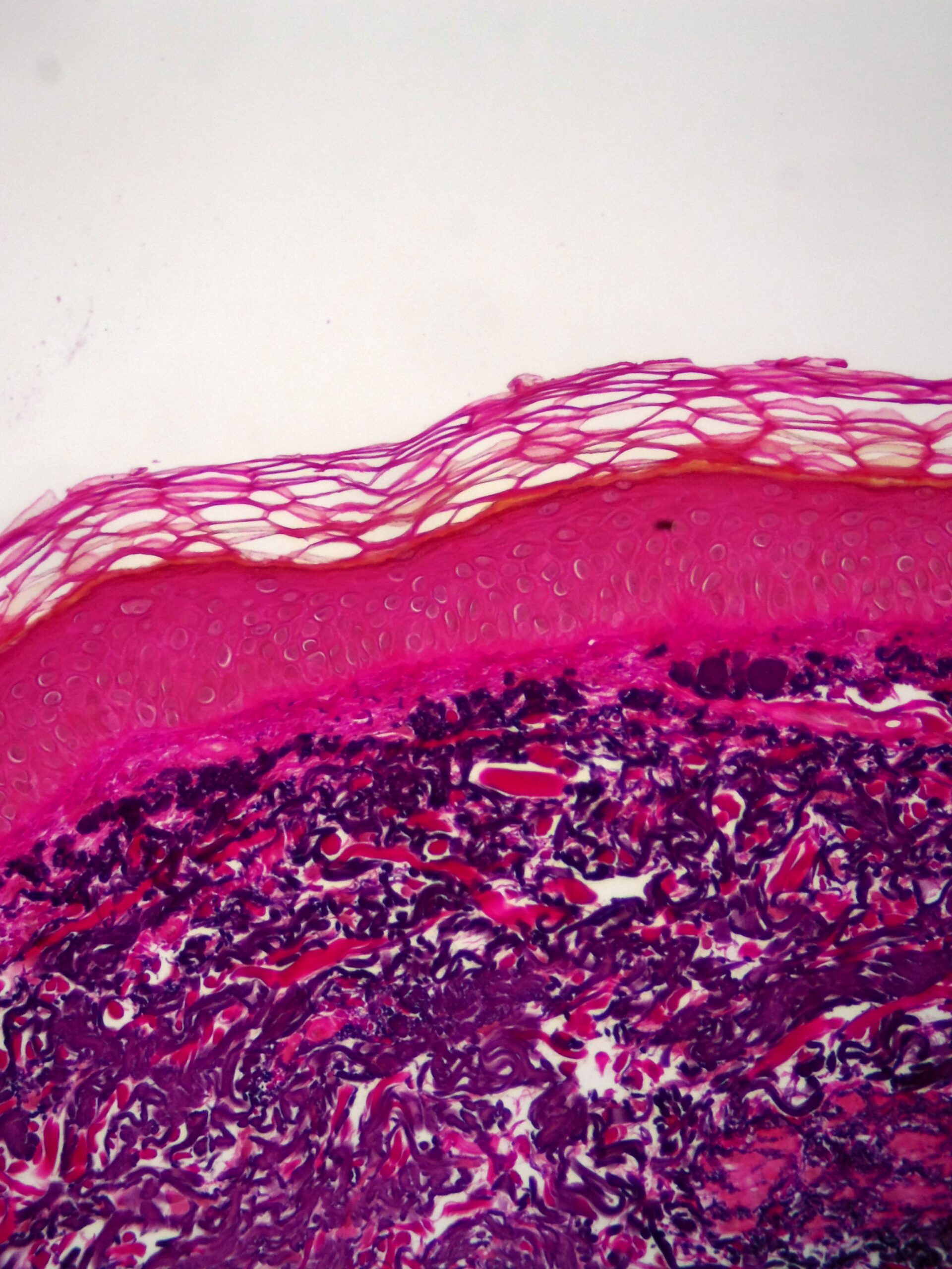 Sun Damaged Skin or Solar Elastosis, EVG Stain