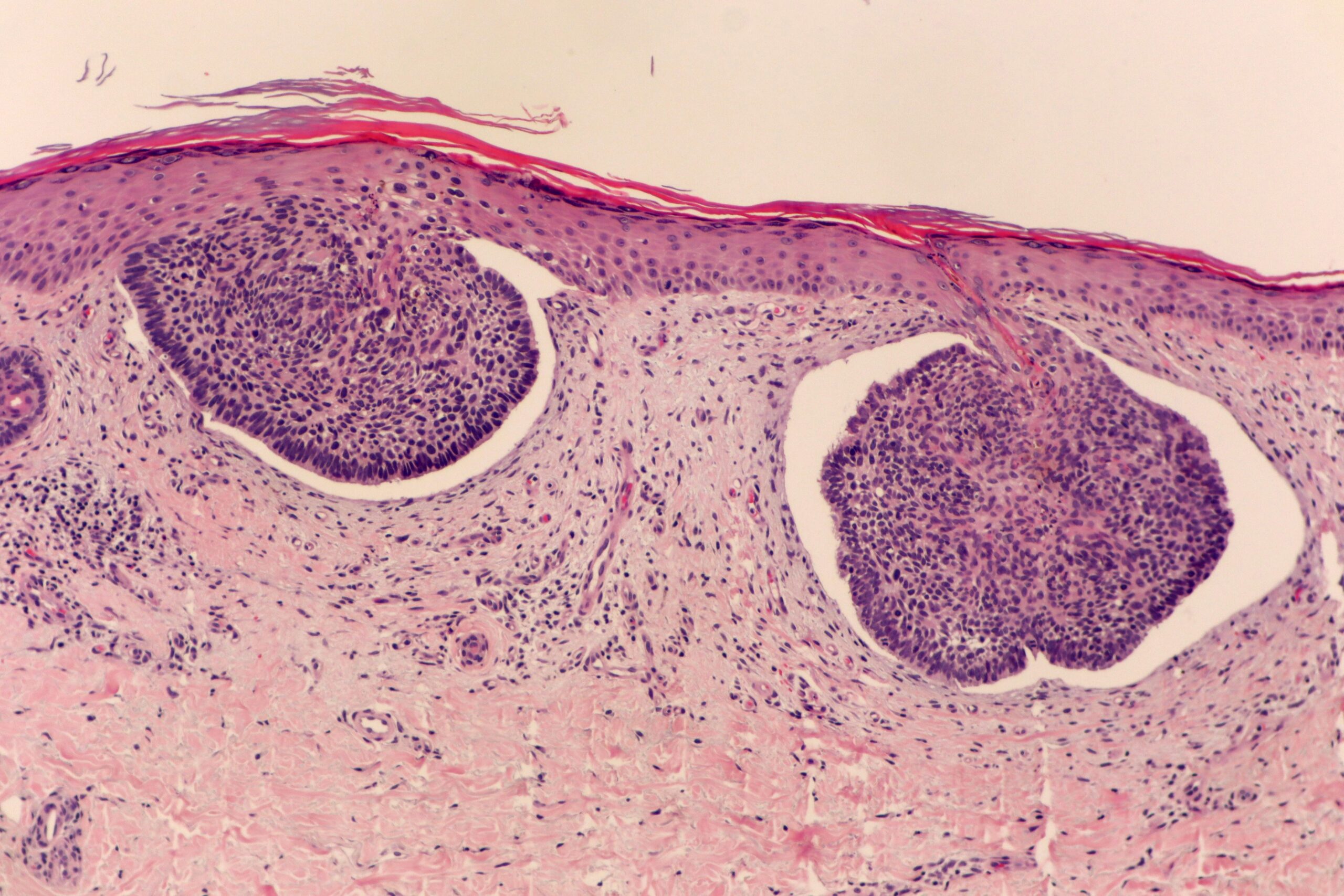Superficial Multicentric Basal Cell Carcinoma