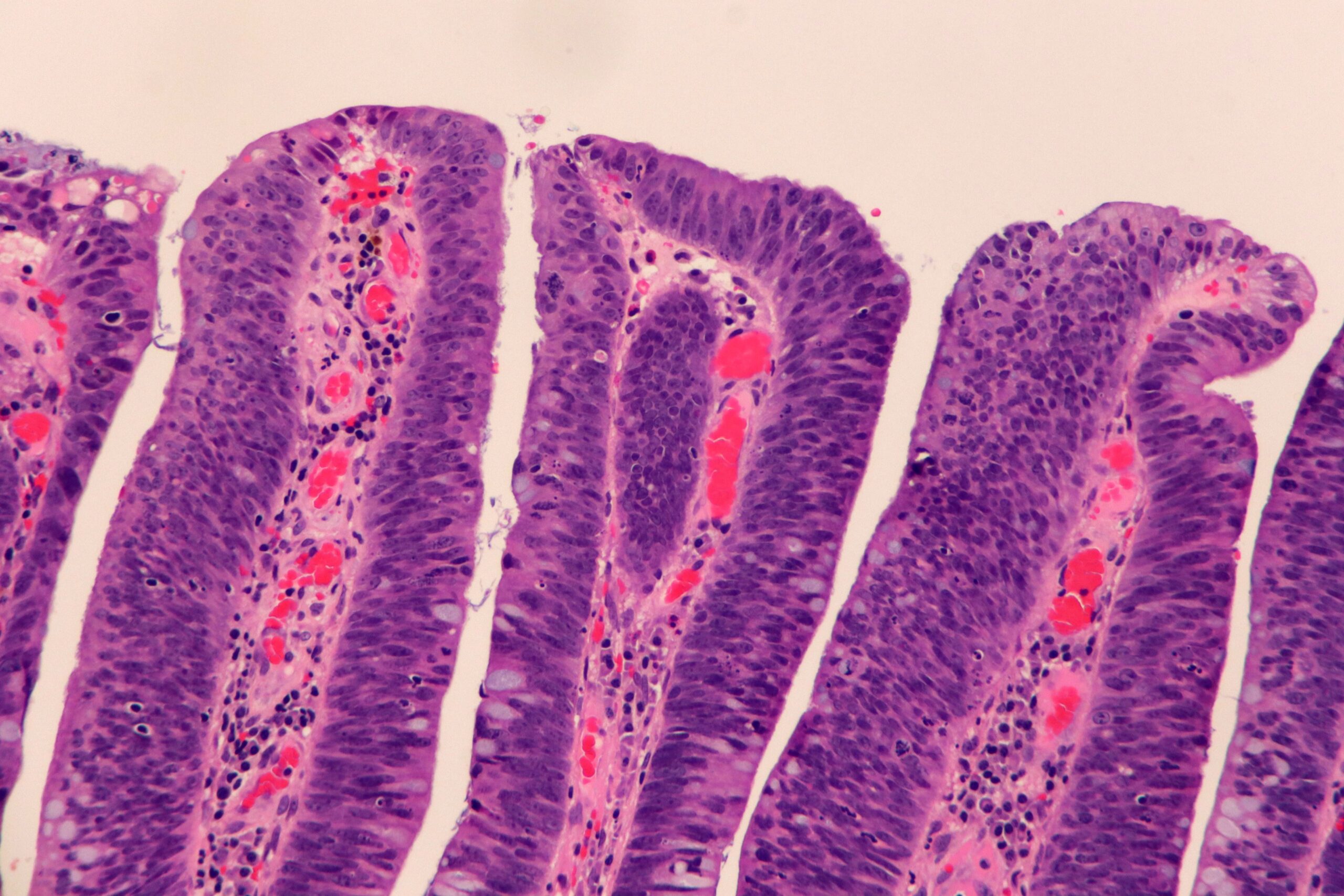 Tubular Adenoma of the Colon