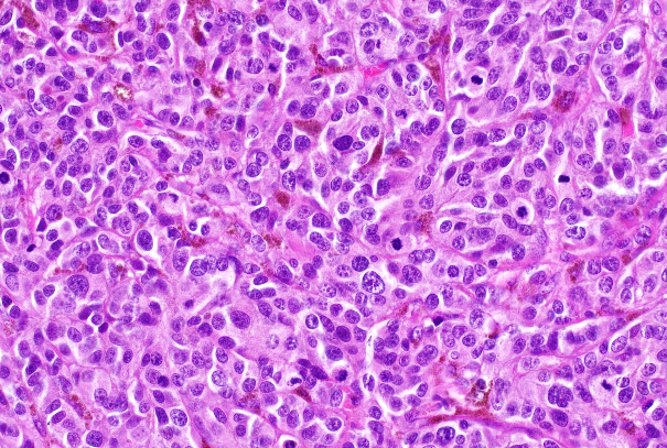 Metastasis of a Malignant Tumor (Melanoma)