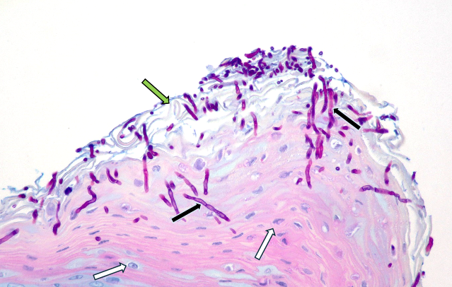 Fungal Infections (Dermatophytosis)
